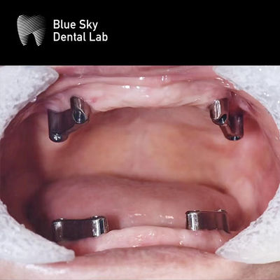 Купить Резиновая зубная зубная титановая снятая система имплантатов Blue Sky online manufacture