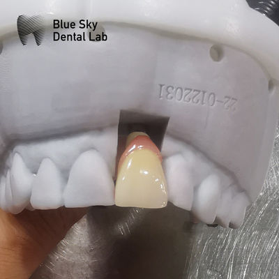 Обычные корпуса для имплантатов Универсальная совместимость